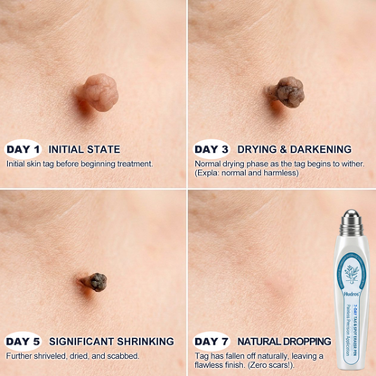 𝑯𝗲𝙖𝐥𝒓𝗶𝙯𝗲® 7-𝐷𝑎𝑦 𝗧𝐚𝐠 & 𝗦𝗽𝐨𝐭 𝐄𝐫𝒂𝒔𝒆𝒓(Zero Pain, Zero 𝐒𝐜𝐚𝒓𝒔 Rollerball)🐳8