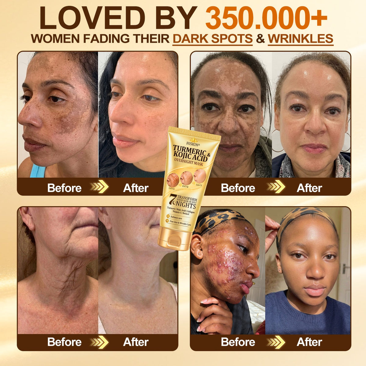 𝑶𝒇𝒇𝒊𝒄𝒊𝒂𝒍 𝑺𝒕𝒐𝒓𝒆 | 𝐍𝐞𝐰! 🚑 𝐇𝐢𝐬𝐤𝐢𝐧® 𝐓𝐮𝐫𝐦𝐞𝐫𝐢𝐜 × 𝐊𝐨𝐣𝐢𝐜 𝐀𝐜𝐢𝐝 𝐎𝐯𝐞𝐫𝐧𝐢𝐠𝐡𝐭 𝐏𝐞𝐞𝐥-𝐎𝐟𝐟 𝐌𝐚𝐬𝐤 — 𝐅𝐚𝐝𝐞 𝐒𝐭𝐮𝐛𝐛𝐨𝐫𝐧 𝐃𝐚𝐫𝐤 𝐒𝐩𝐨𝐭𝐬 & 𝐒𝐦𝐨𝐨𝐭𝐡 𝐕𝐢𝐬𝐢𝐛𝐥𝐞 𝐖𝐫𝐢𝐧𝐤𝐥𝐞𝐬 𝐖𝐡𝐢𝐥𝐞 𝐘𝐨𝐮 𝐒𝐥𝐞𝐞𝐩 🌙✨ 𝐓𝐮𝐫𝐦𝐞𝐫𝐢𝐜 × 𝐊𝐨𝐣𝐢𝐜 𝐀𝐜𝐢𝐝 × 𝐏𝐞𝐩𝐭𝐢𝐝𝐞𝐬 ✅ 𝐎𝐧𝐞 𝐒𝐭𝐞𝐩 𝐚 𝐍𝐢𝐠𝐡𝐭 · 𝐕𝐢𝐬𝐢𝐛𝐥𝐞 𝐂𝐡𝐚𝐧𝐠𝐞𝐬 𝐢𝐧 𝟕 𝐍𝐢𝐠𝐡𝐭𝐬 💯